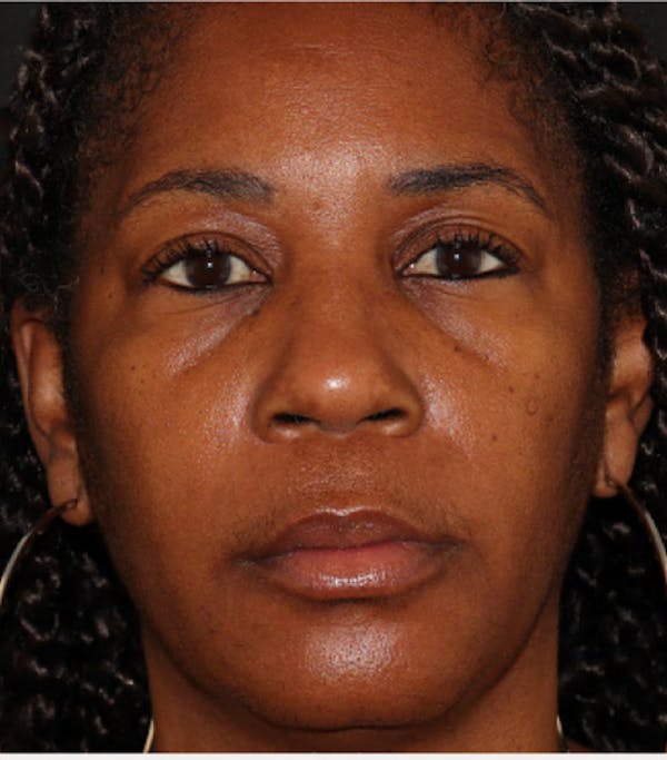 Under Eye Filler Before & After Gallery - Patient 106091 - Image 1
