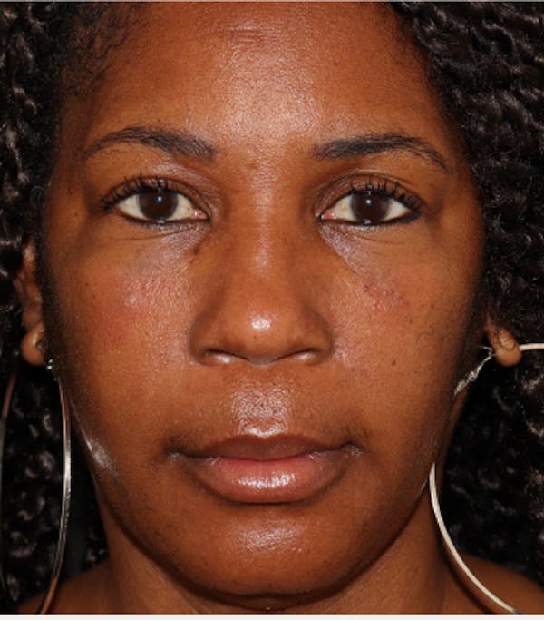 Under Eye Filler Before & After Gallery - Patient 106091 - Image 2