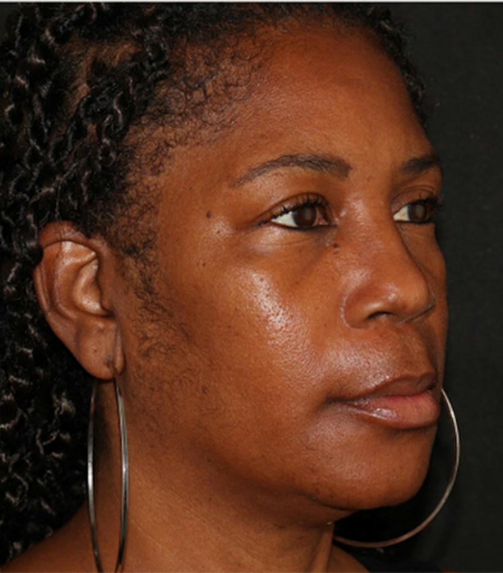 Under Eye Filler Before & After Gallery - Patient 106091 - Image 3