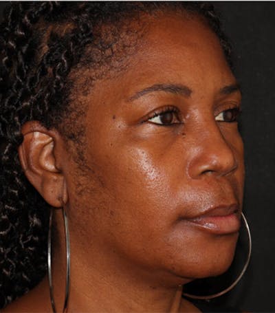 Under Eye Filler Before & After Gallery - Patient 106091 - Image 3