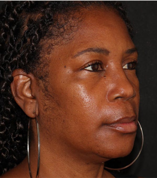 Under Eye Filler Before & After Gallery - Patient 106091 - Image 3