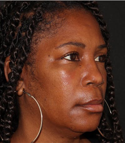 Under Eye Filler Before & After Gallery - Patient 106091 - Image 4