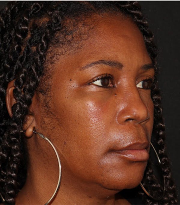 Under Eye Filler Before & After Gallery - Patient 106091 - Image 4