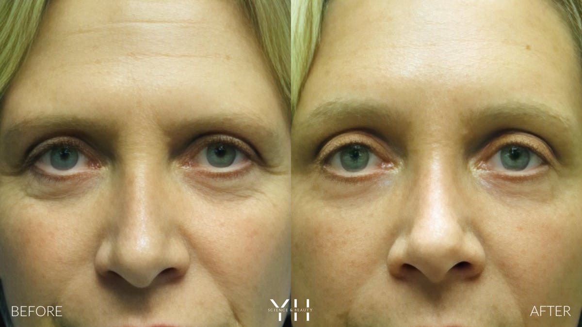 Brow Lift Before & After Gallery - Patient 25139885 - Image 1
