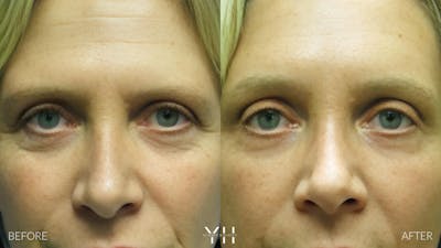Brow Lift Before & After Gallery - Patient 25139885 - Image 1