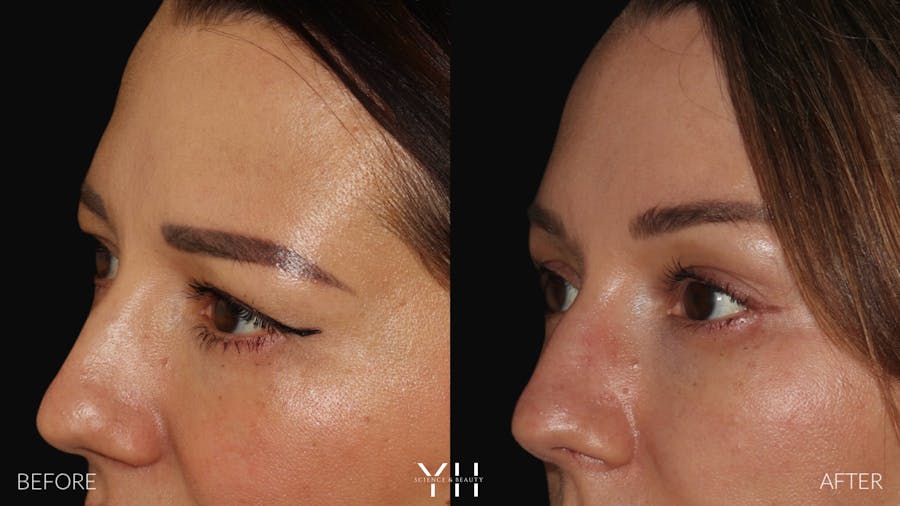 Brow Lift Before & After Gallery - Patient 25139957 - Image 4