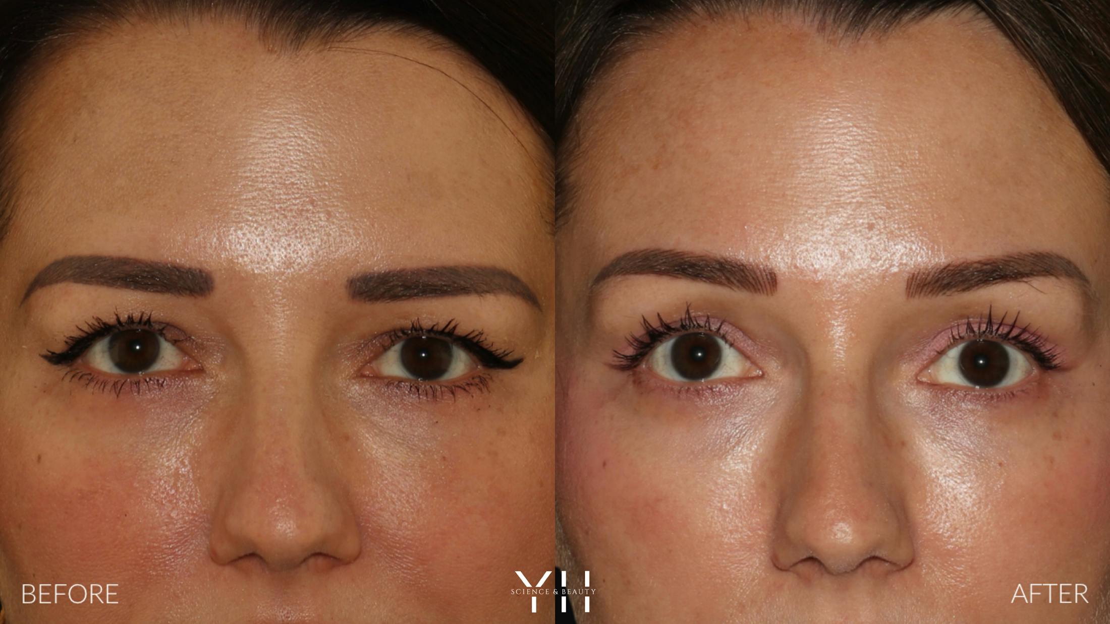 Brow Lift Before & After Gallery - Patient 25139957 - Image 1
