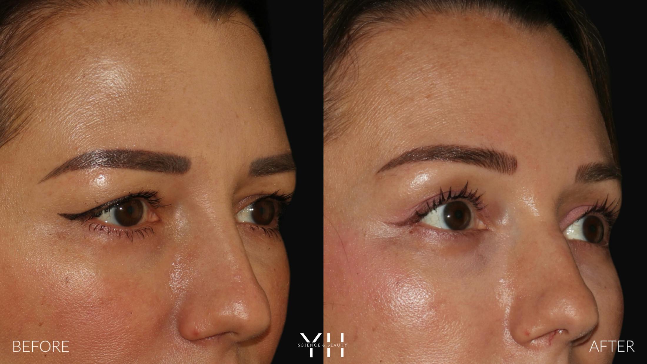 Brow Lift Before & After Gallery - Patient 25139957 - Image 2