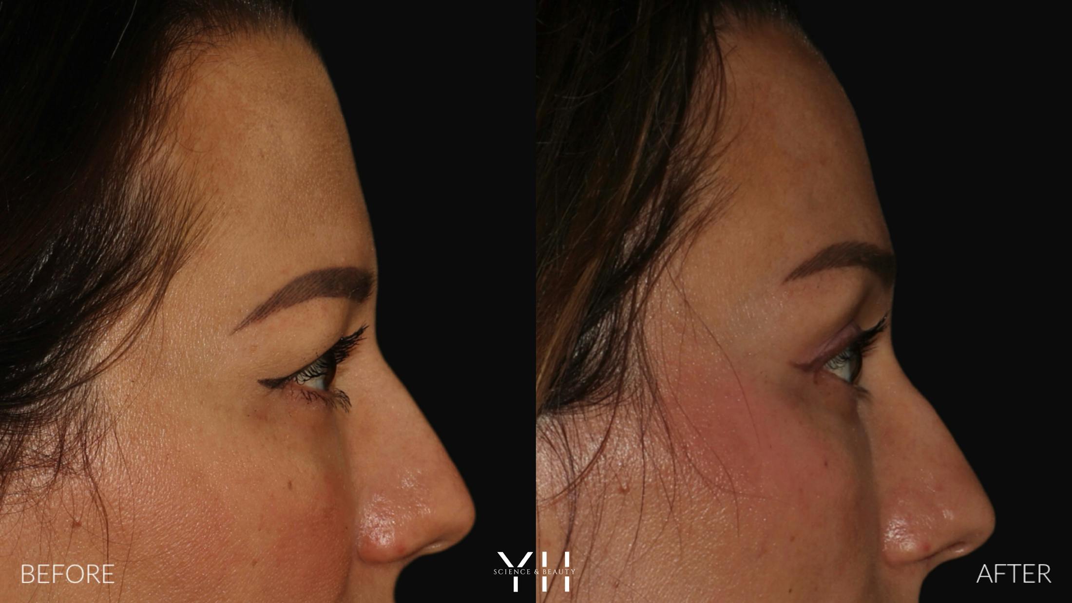 Brow Lift Before & After Gallery - Patient 25139957 - Image 3
