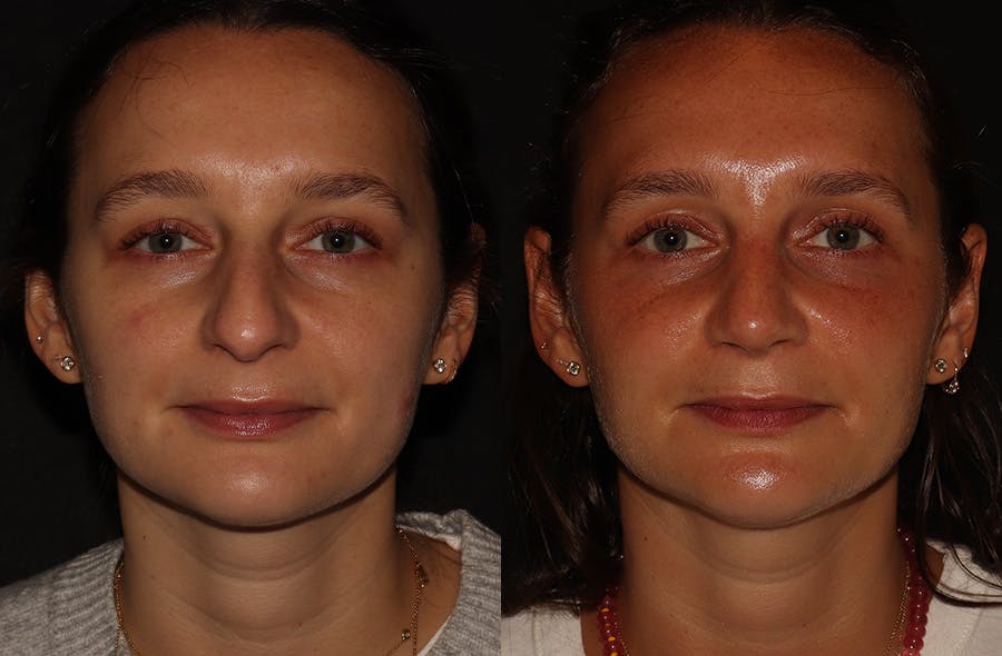 Rhinoplasty Before & After Gallery - Patient 297719 - Image 3
