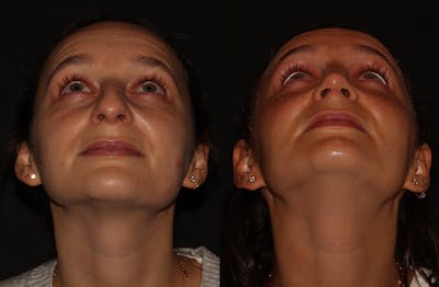 Rhinoplasty Before & After Gallery - Patient 297719 - Image 4