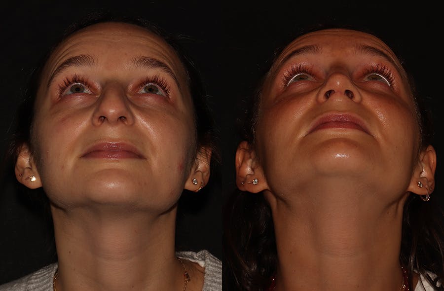 Rhinoplasty Before & After Gallery - Patient 297719 - Image 4