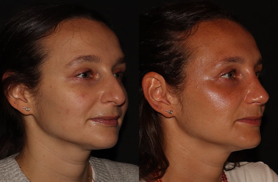 Rhinoplasty Before & After Gallery - Patient 297719 - Image 2