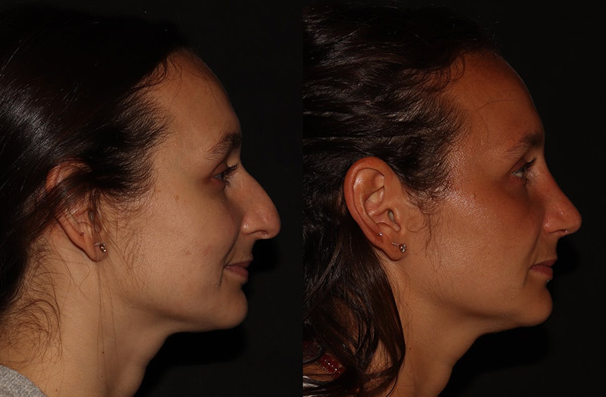 Rhinoplasty Before & After Gallery - Patient 297719 - Image 1