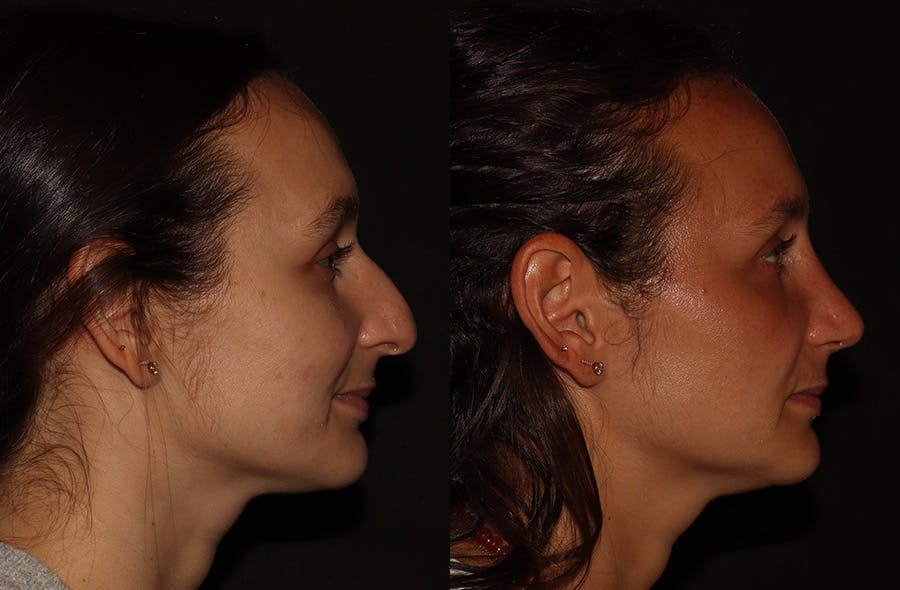 Rhinoplasty Before & After Gallery - Patient 297719 - Image 1