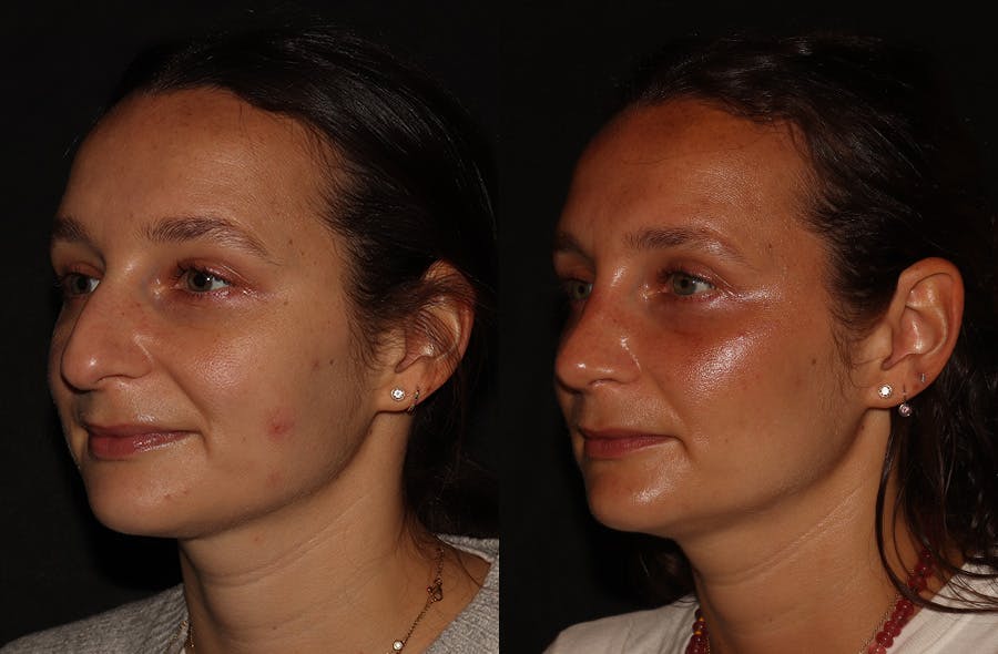 Rhinoplasty Before & After Gallery - Patient 297719 - Image 5