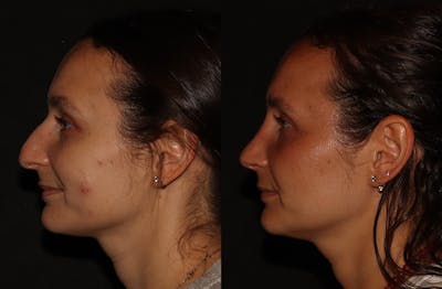 Rhinoplasty Before & After Gallery - Patient 297719 - Image 6