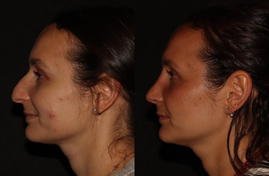 Rhinoplasty Before & After Gallery - Patient 297719 - Image 6