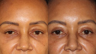  Blepharoplasty Before & After Gallery - Patient 746491 - Image 1
