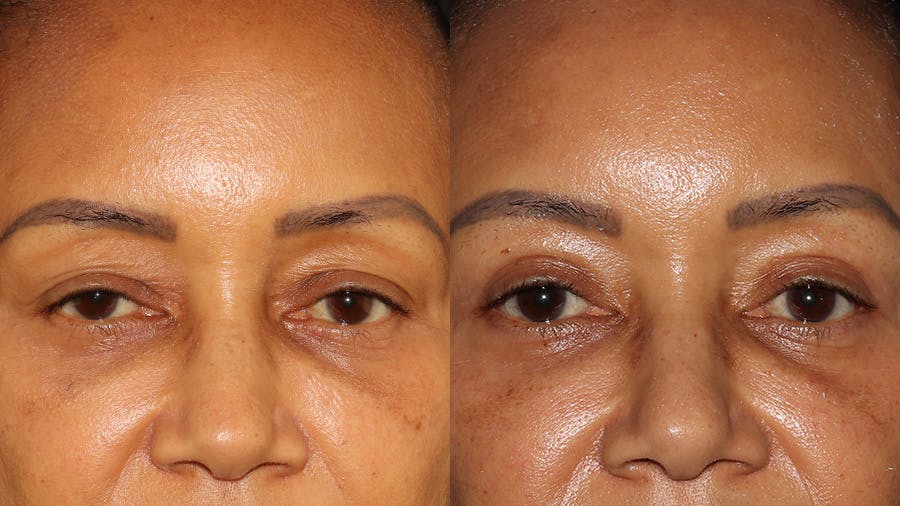  Blepharoplasty Before & After Gallery - Patient 746491 - Image 1