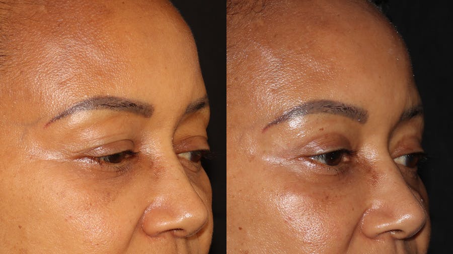  Blepharoplasty Before & After Gallery - Patient 746491 - Image 2
