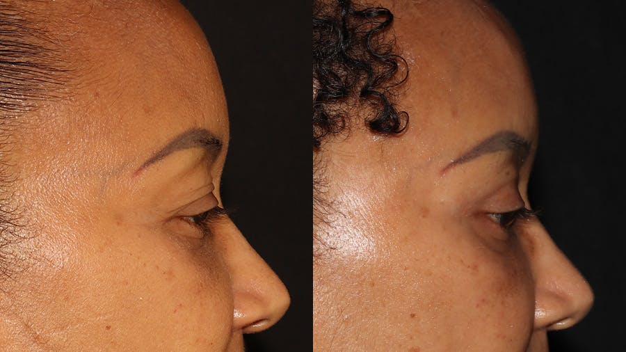  Blepharoplasty Before & After Gallery - Patient 746491 - Image 3