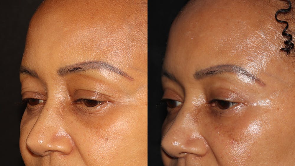  Blepharoplasty Before & After Gallery - Patient 746491 - Image 4