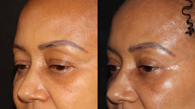  Blepharoplasty Before & After Gallery - Patient 746491 - Image 4