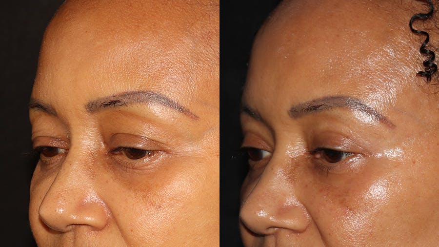  Blepharoplasty Before & After Gallery - Patient 746491 - Image 4