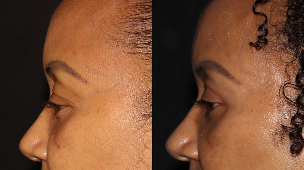  Blepharoplasty Before & After Gallery - Patient 746491 - Image 5
