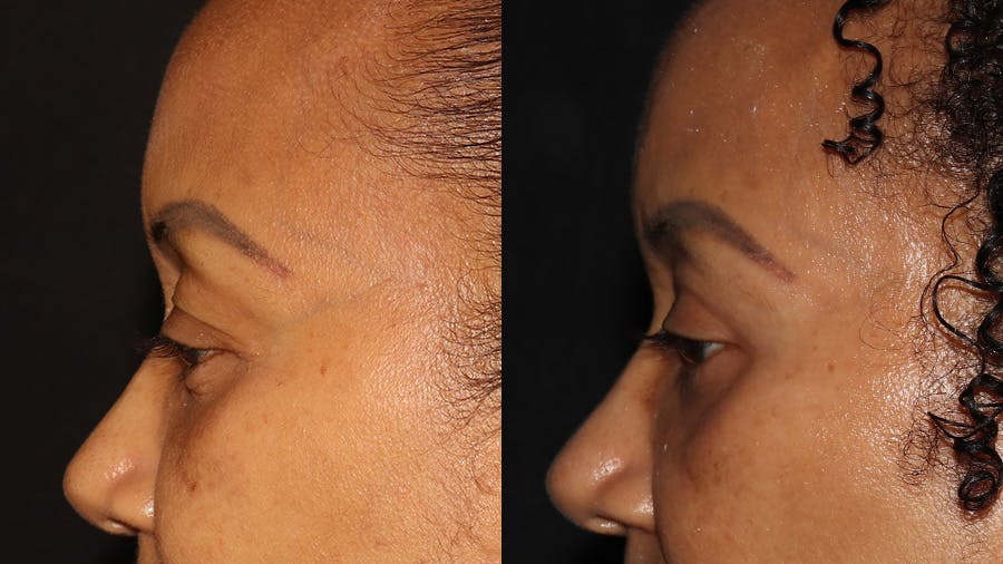  Blepharoplasty Before & After Gallery - Patient 746491 - Image 5
