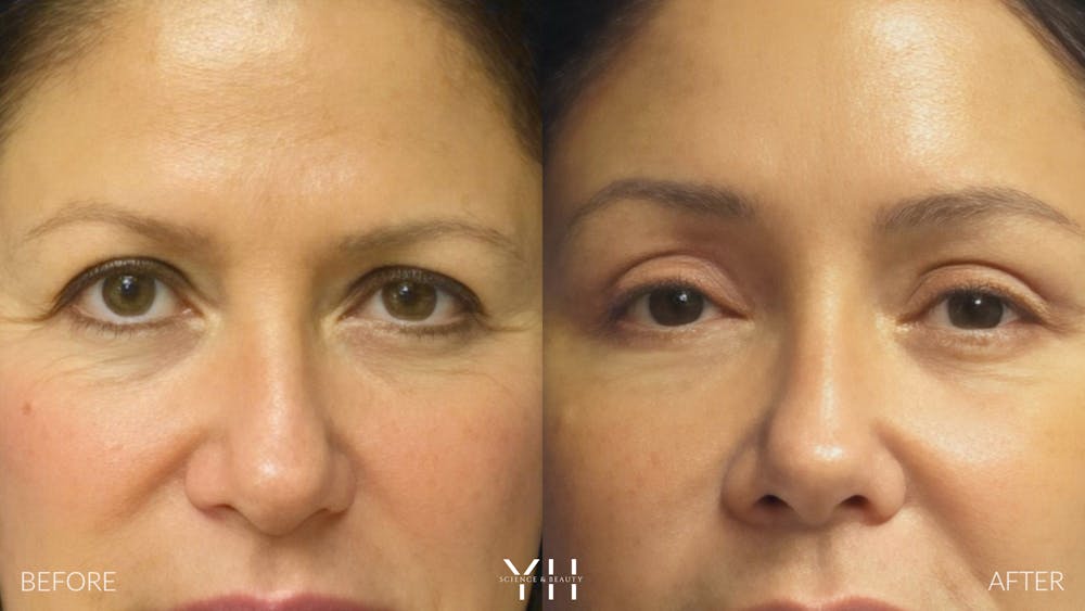 Brow Lift Before & After Gallery - Patient 25139866 - Image 1