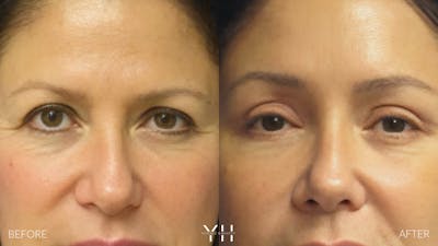 Brow Lift Before & After Gallery - Patient 25139866 - Image 1
