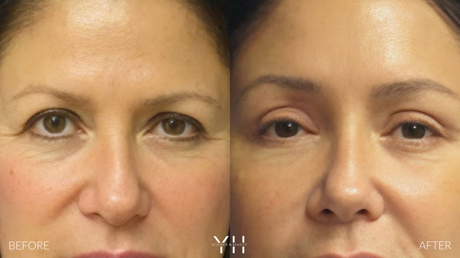 Brow Lift Before & After Gallery - Patient 25139866 - Image 1