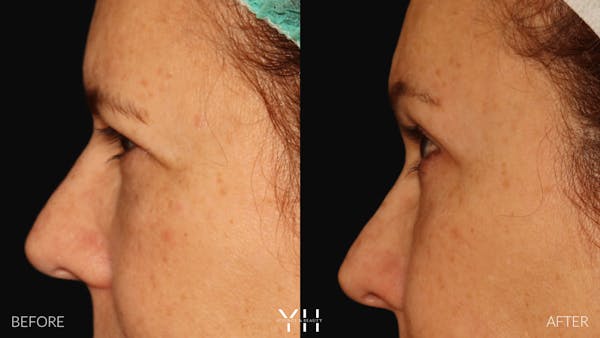 Brow Lift Before & After Gallery - Patient 128048 - Image 5