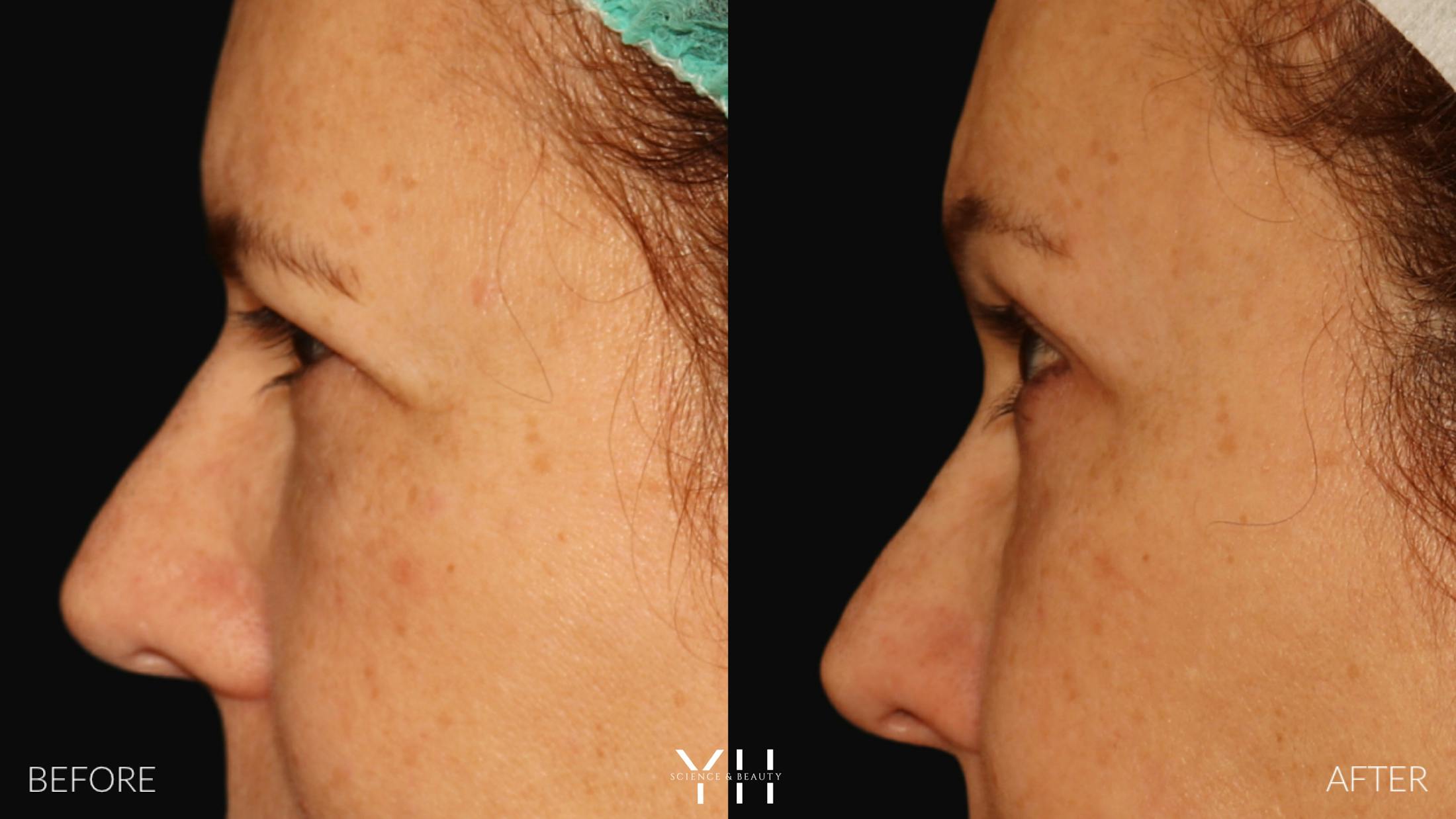 Brow Lift Before & After Gallery - Patient 128048 - Image 5