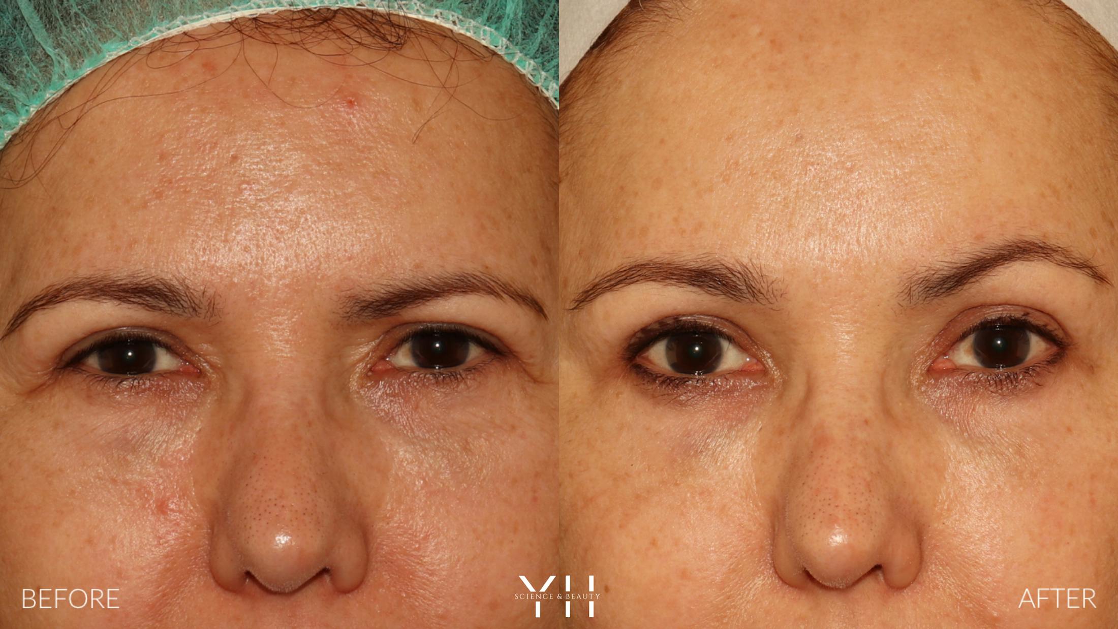 Brow Lift Before & After Gallery - Patient 128048 - Image 1