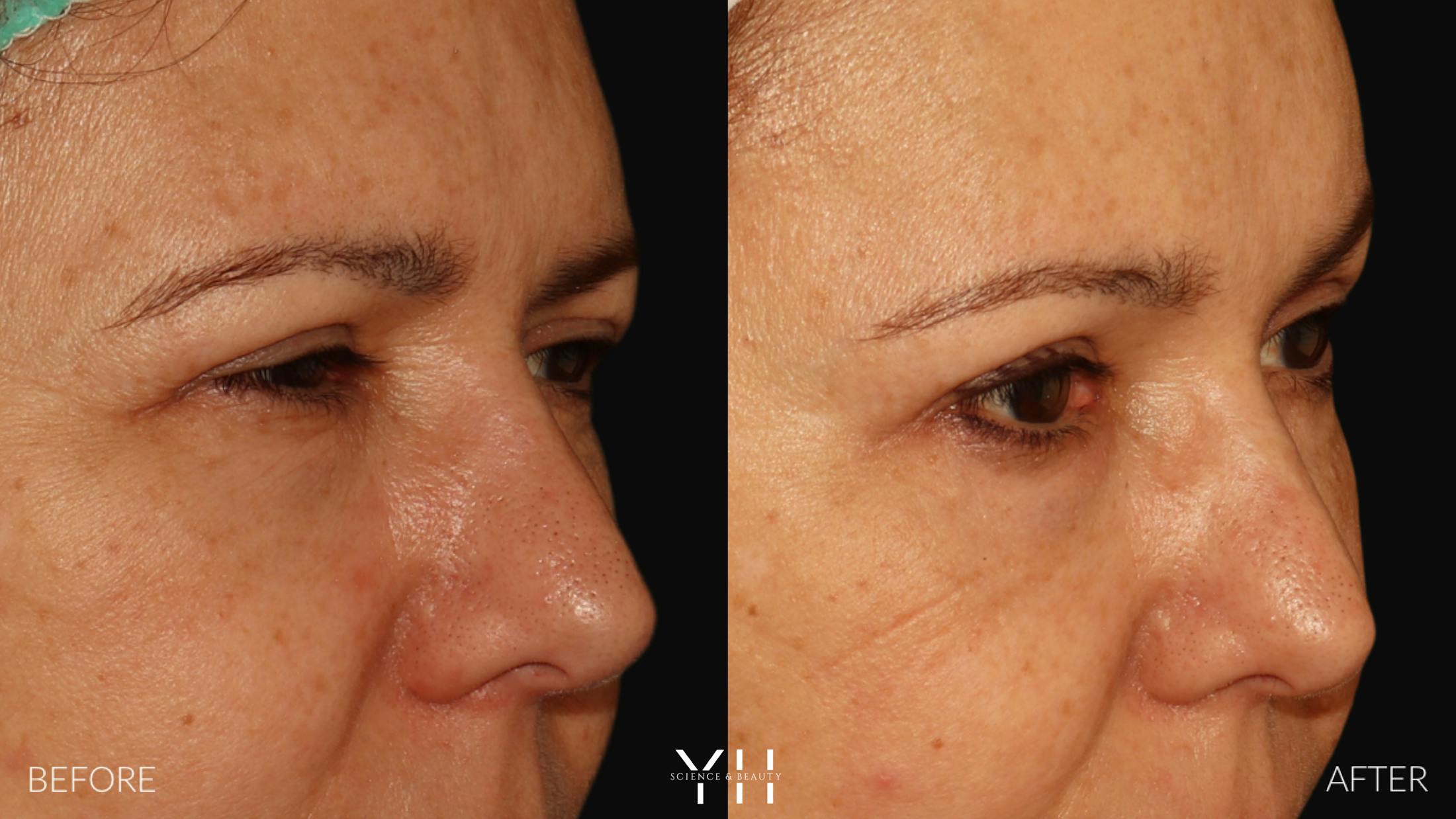 Brow Lift Before & After Gallery - Patient 128048 - Image 2