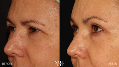 Brow Lift Before & After Gallery - Patient 128048 - Image 4