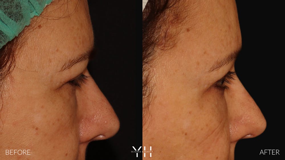 Brow Lift Before & After Gallery - Patient 128048 - Image 3