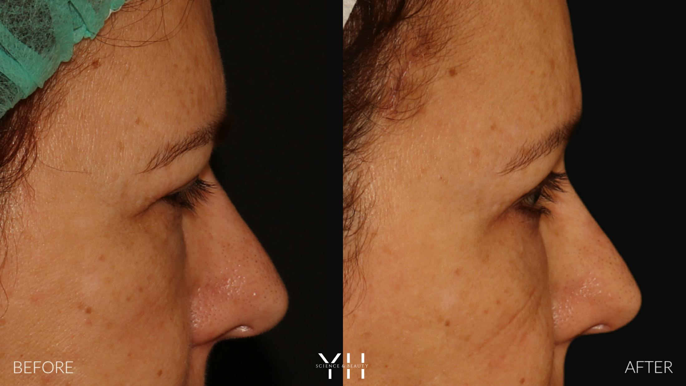 Brow Lift Before & After Gallery - Patient 128048 - Image 3