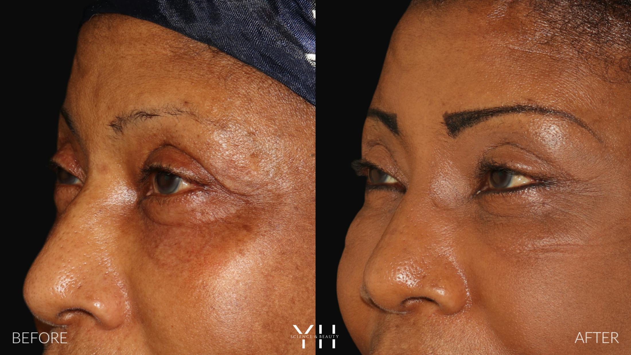 Brow Lift Before & After Gallery - Patient 304431 - Image 4
