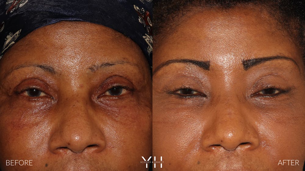 Brow Lift Before & After Gallery - Patient 304431 - Image 1