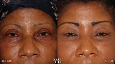 Brow Lift Before & After Gallery - Patient 304431 - Image 1