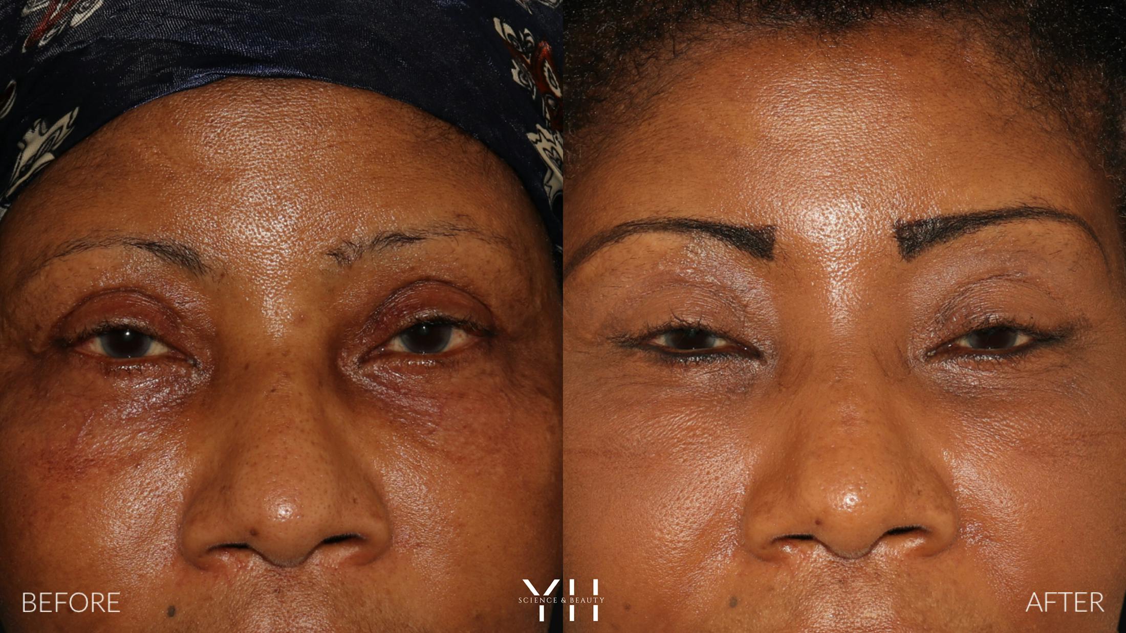 Brow Lift Before & After Gallery - Patient 304431 - Image 1