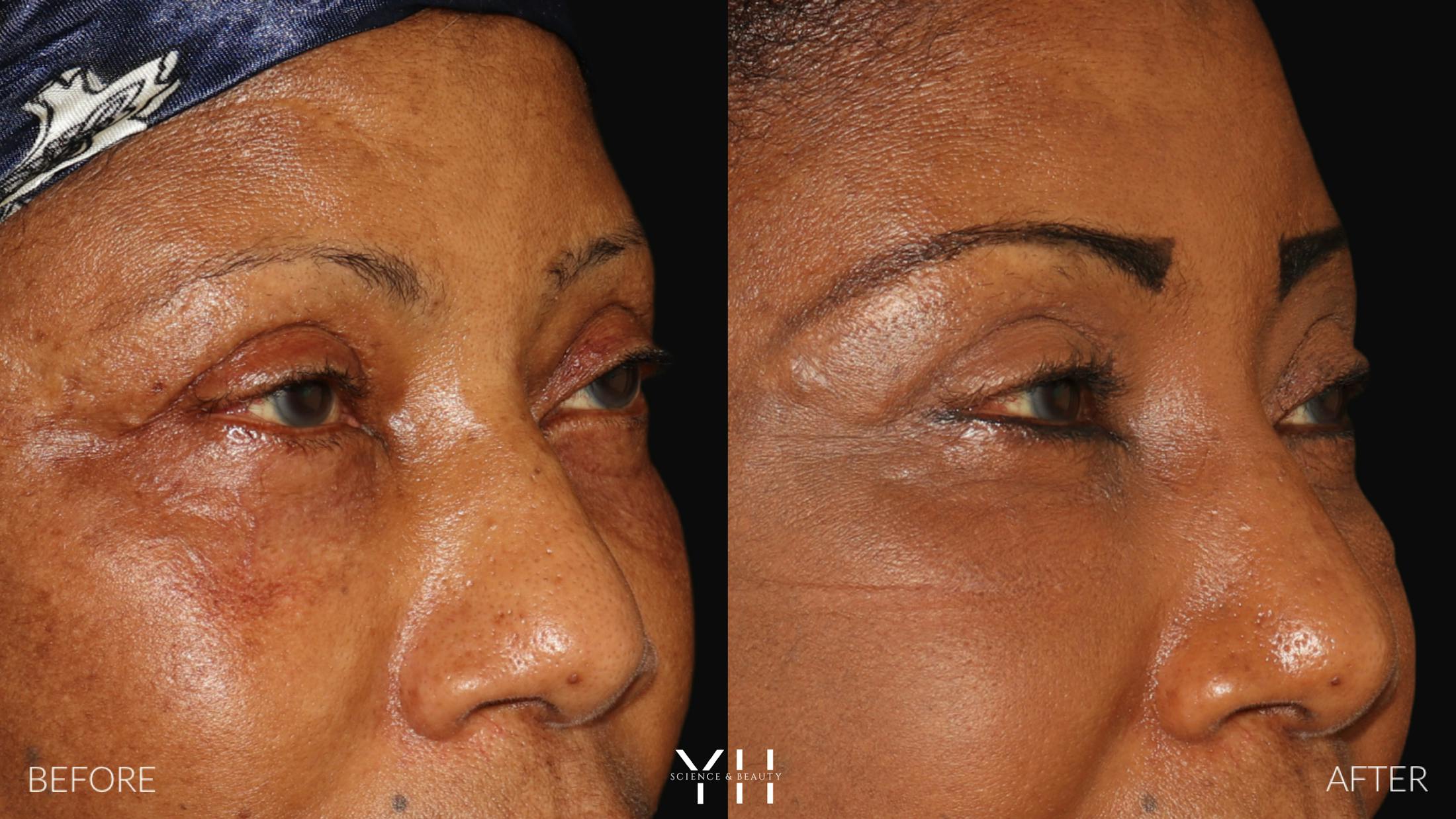 Brow Lift Before & After Gallery - Patient 304431 - Image 2