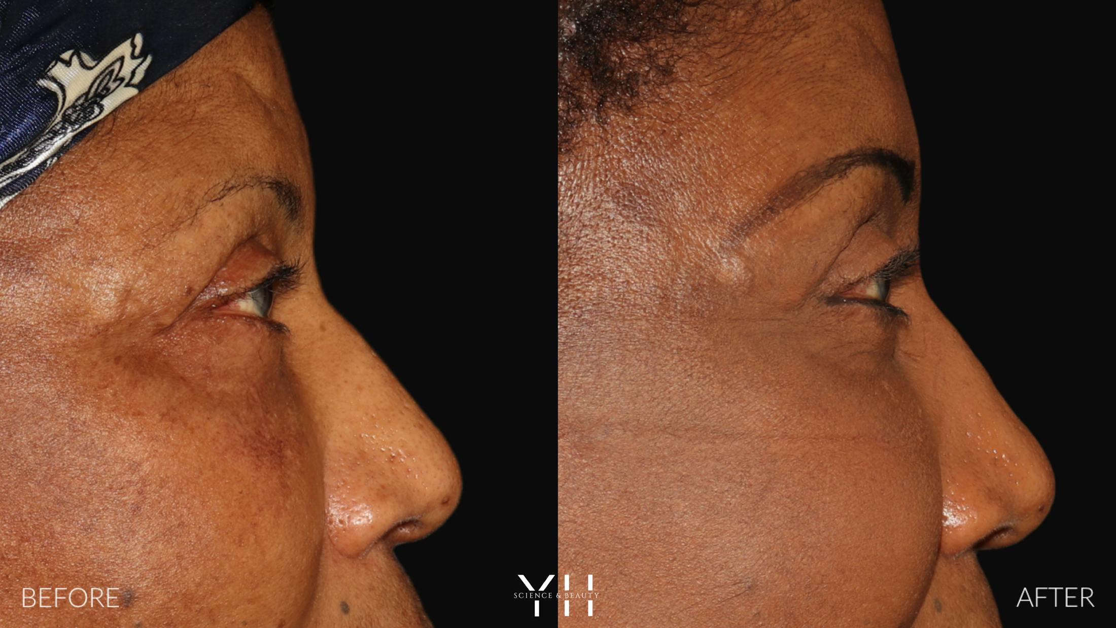 Brow Lift Before & After Gallery - Patient 304431 - Image 3
