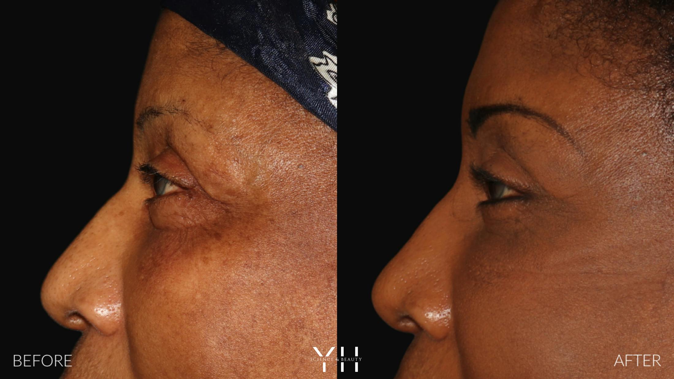 Brow Lift Before & After Gallery - Patient 304431 - Image 5