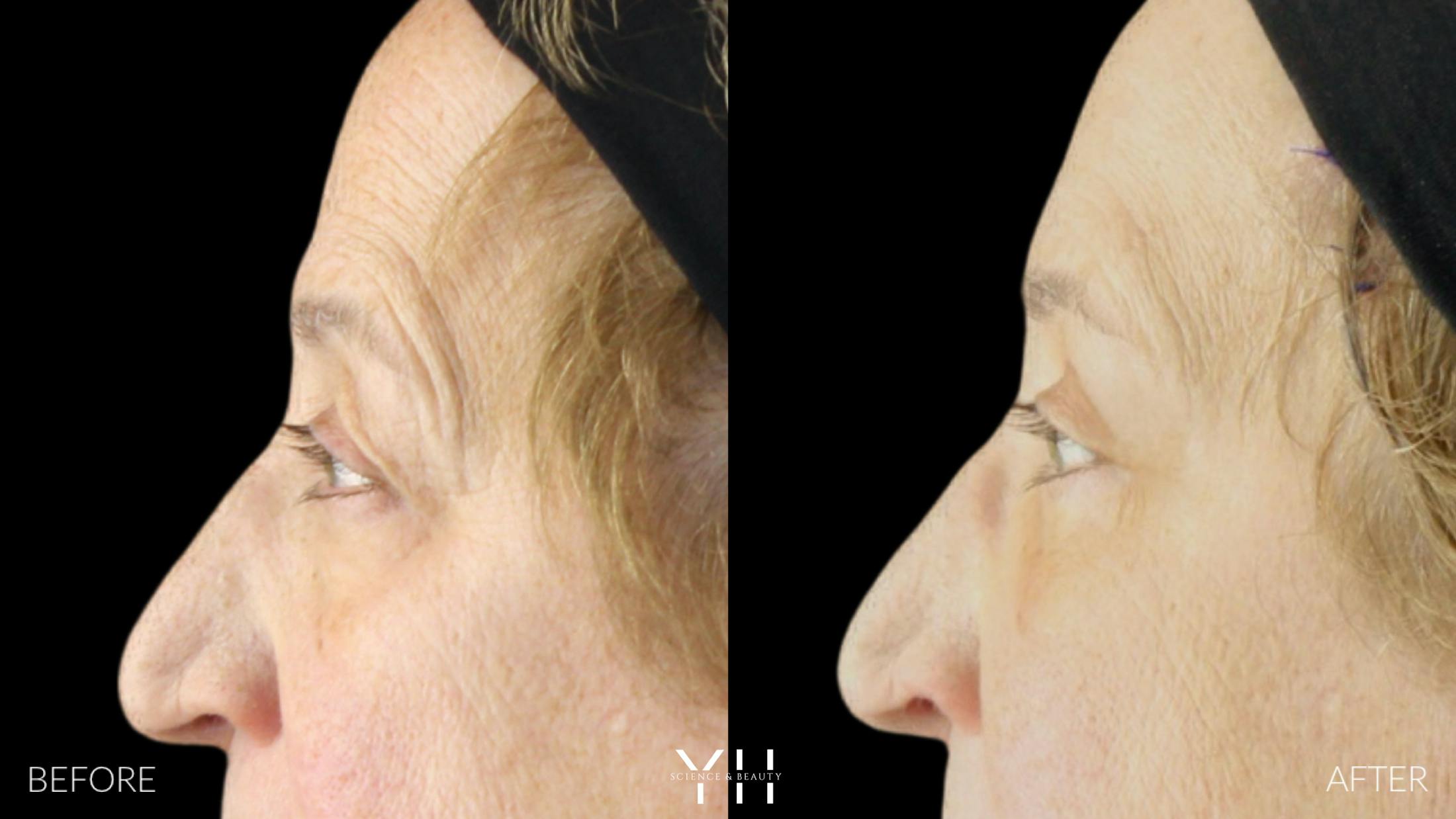 Brow Lift Before & After Gallery - Patient 421725 - Image 5