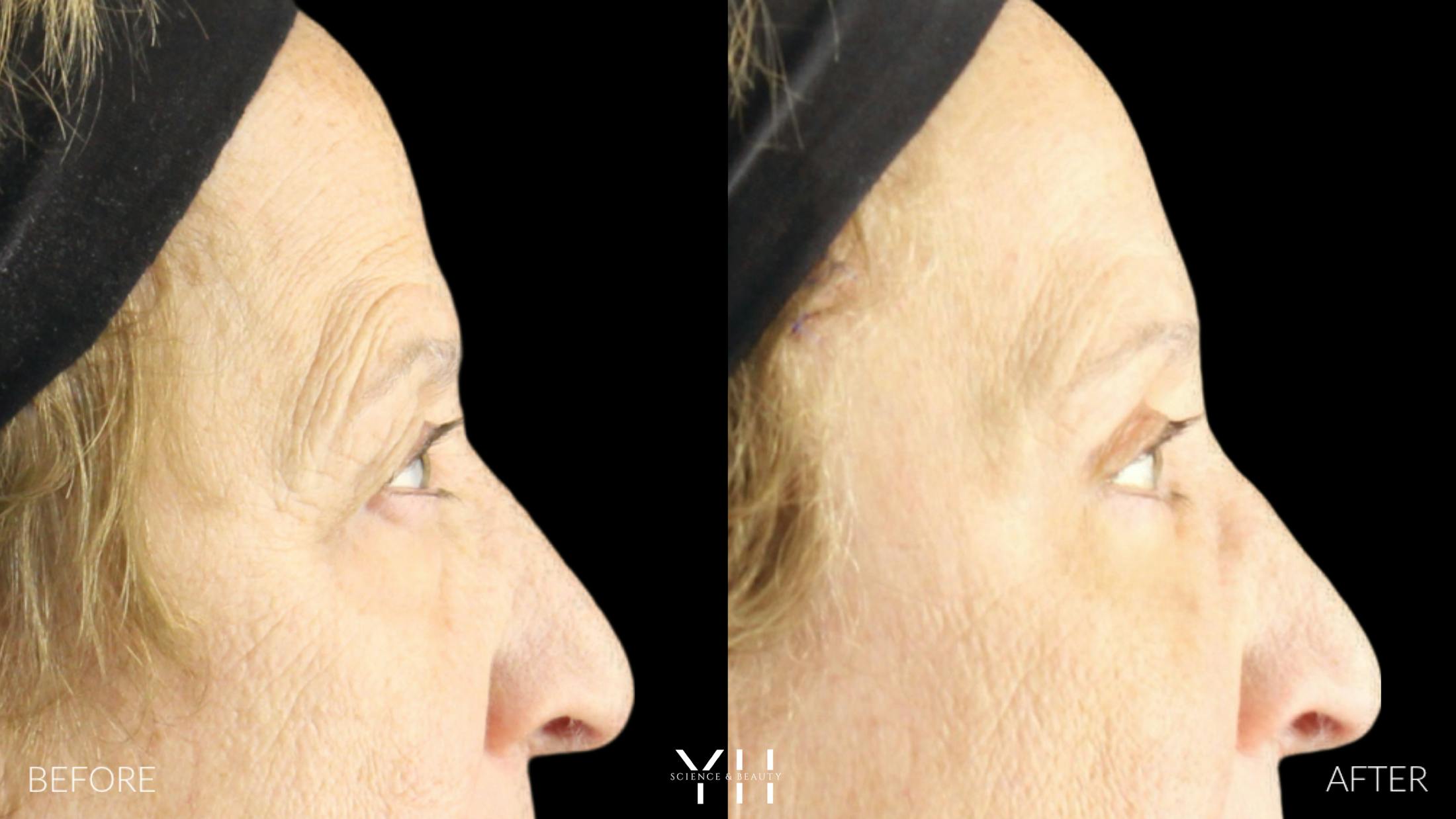 Brow Lift Before & After Gallery - Patient 421725 - Image 3